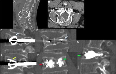 Re-expansion of vertebral compression fractures in patients with multiple myeloma with percutaneous vertebroplasty using spinejack implants: a preliminary and retrospective study